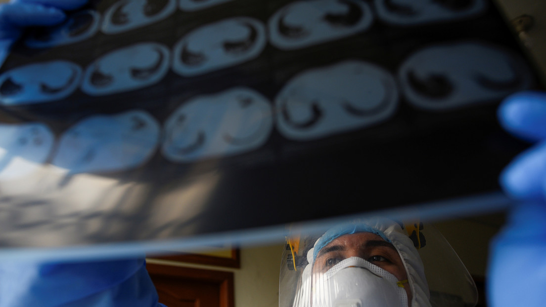 Médicos mexicanos realizan el primer trasplante doble de pulmón a un paciente que contrajo coronavirus